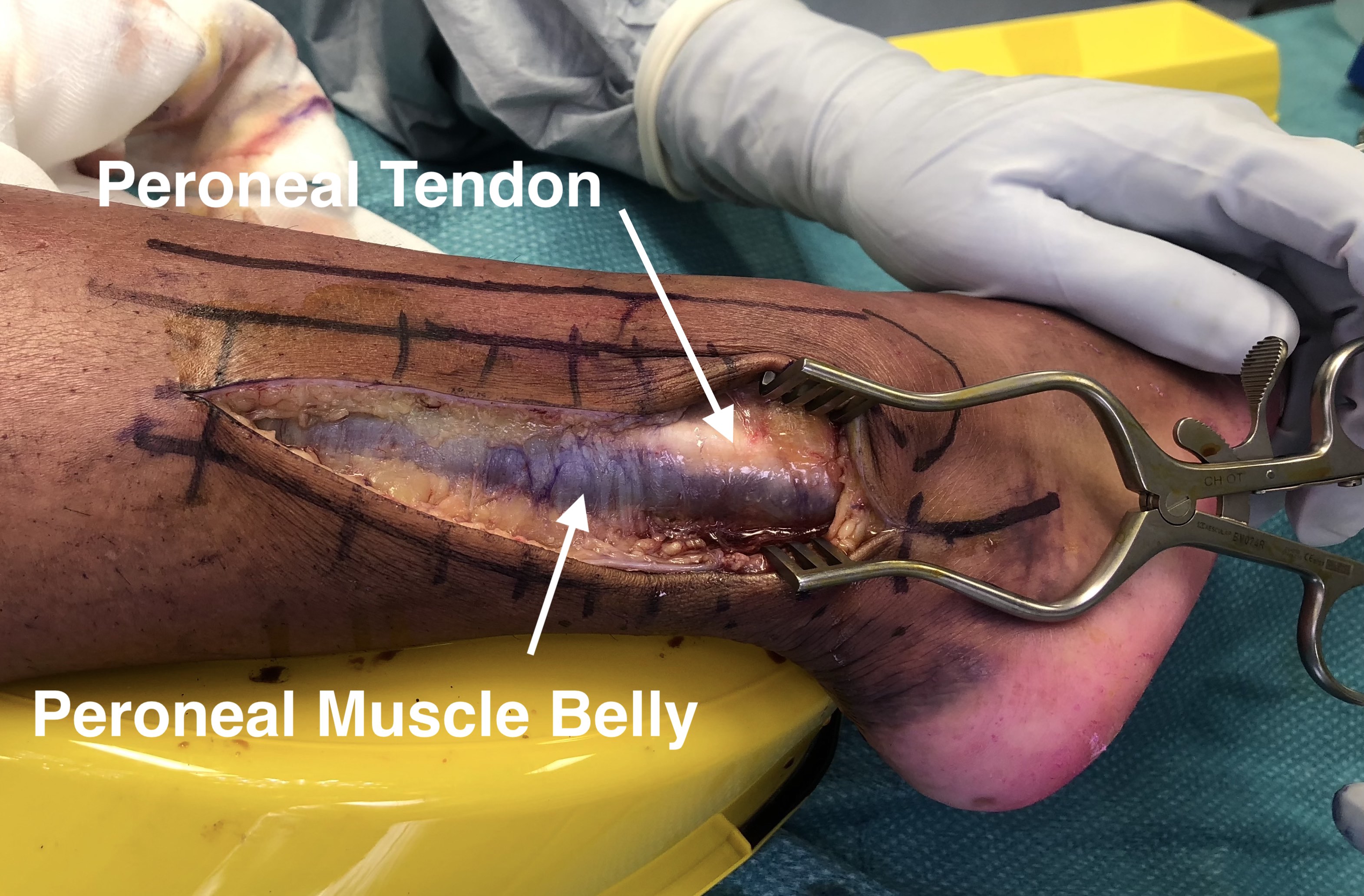 Ankle PL Approach 2